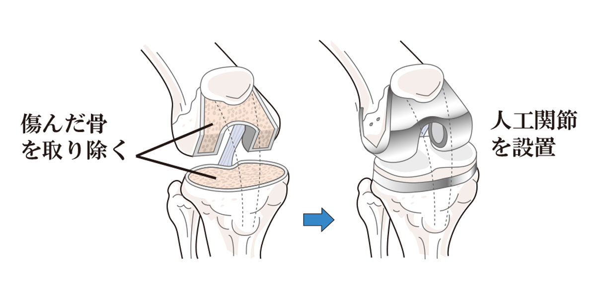 人工膝関節全置換術のイメージ画像